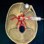 Depiction of focused ultrasound treatment of the nucleus accumbens.