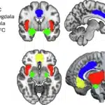 fMRI imagery showing emotional processing brain regions including the extended amygdala, insula, ACC, and mPFC.