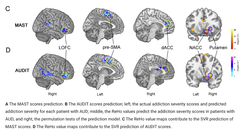How Alcohol Use Disorder Affects the Brain > AddictionNews