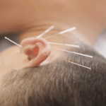 Acupuncture