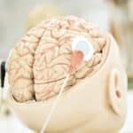 depiction of a brain with headphones symbolizing deep brain stimulation