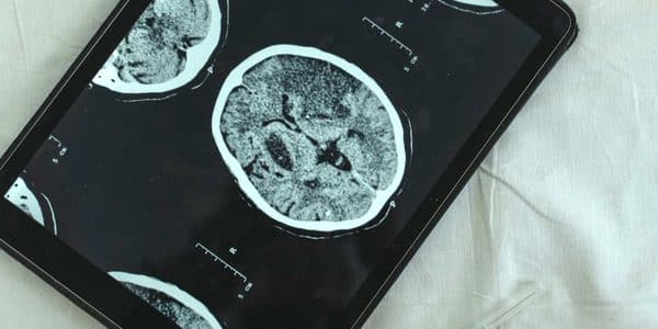 An image of a brain scan on a tablet.